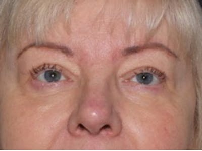 Blepharoplasty & Browlift Before & After Gallery - Patient 134102 - Image 2