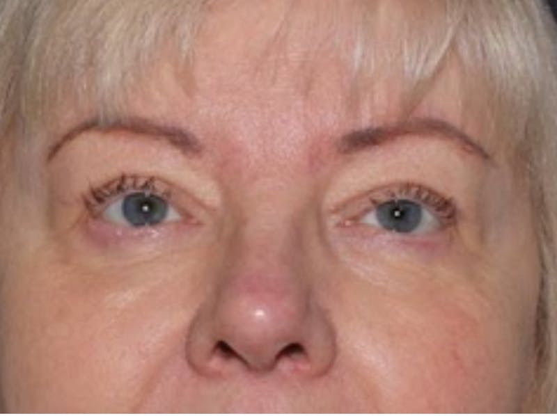 Blepharoplasty & Browlift Before & After Gallery - Patient 134102 - Image 2