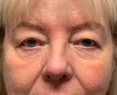 Blepharoplasty & Browlift Before & After Gallery - Patient 134102 - Image 1