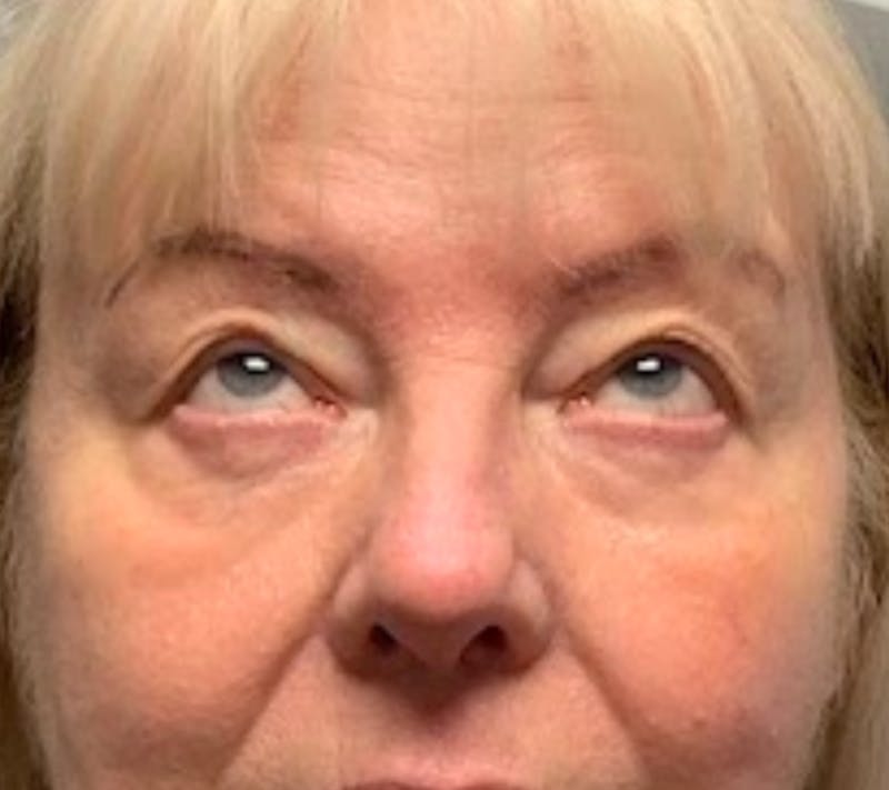 Blepharoplasty & Browlift Before & After Gallery - Patient 134102 - Image 3