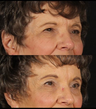 Blepharoplasty & Browlift Before & After Gallery - Patient 178146 - Image 1