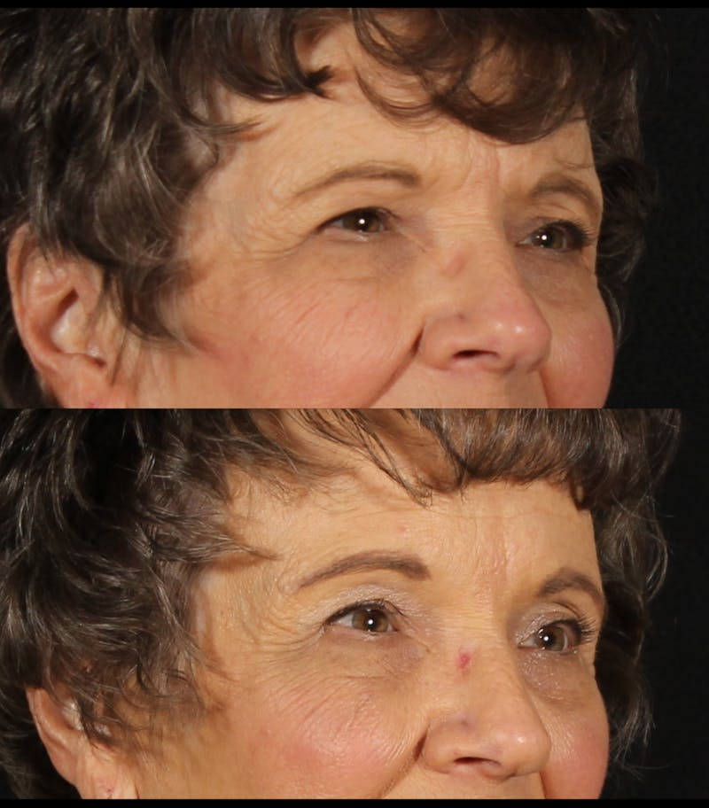 Blepharoplasty & Browlift Before & After Gallery - Patient 178146 - Image 2