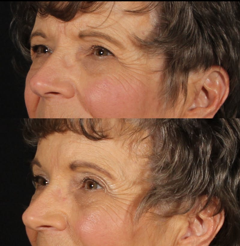 Blepharoplasty & Browlift Before & After Gallery - Patient 178146 - Image 3