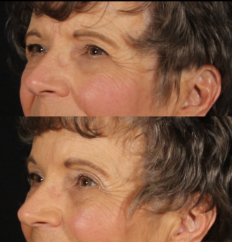 Blepharoplasty & Browlift Before & After Gallery - Patient 178146 - Image 4