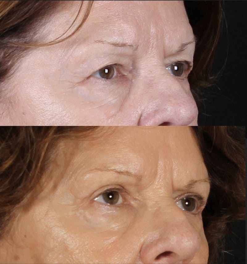 Blepharoplasty & Browlift Before & After Gallery - Patient 334684 - Image 5