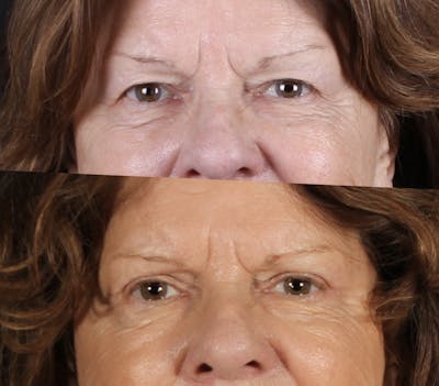 Blepharoplasty & Browlift Before & After Gallery - Patient 334684 - Image 1