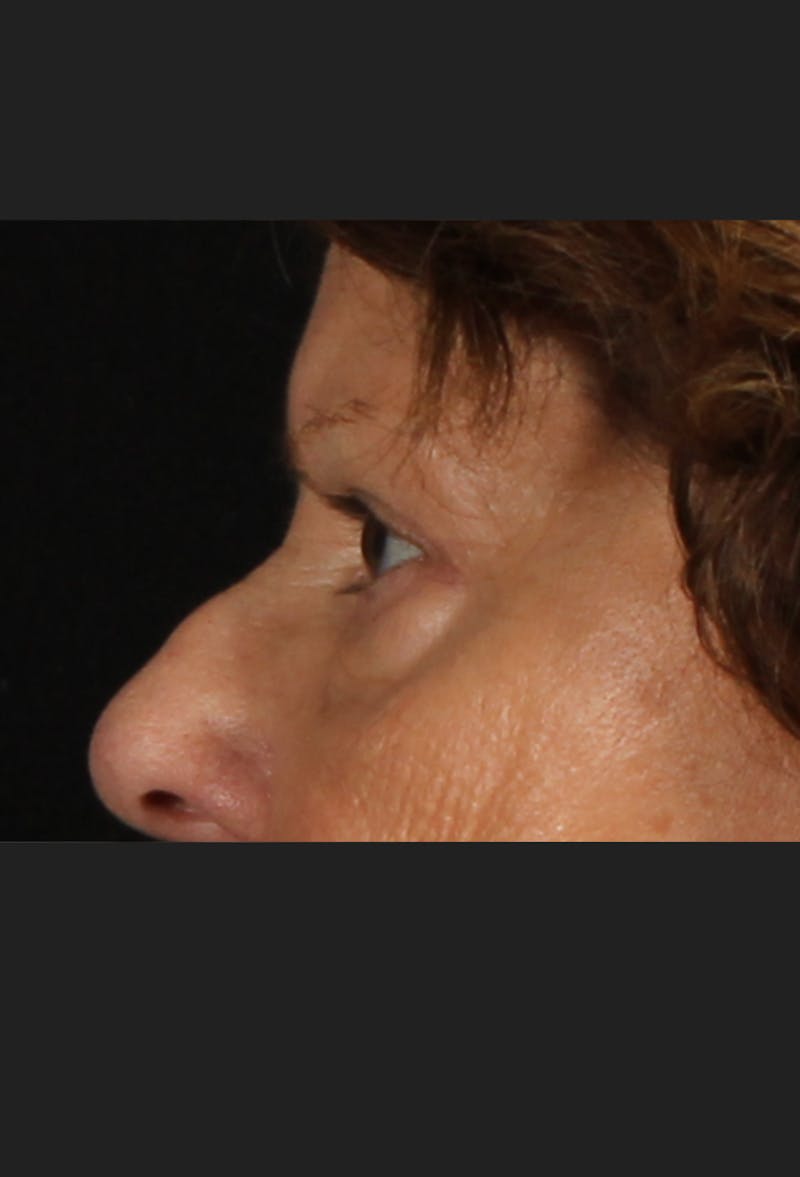 Blepharoplasty & Browlift Before & After Gallery - Patient 334684 - Image 8