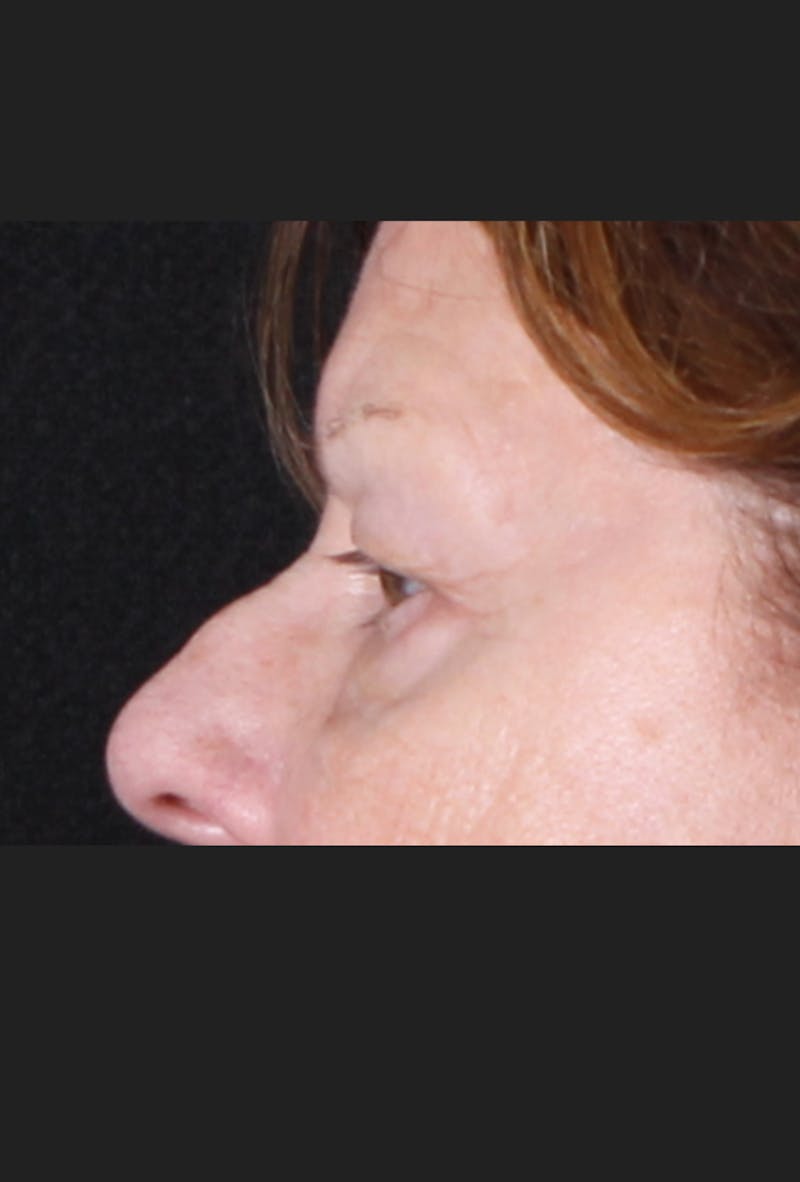 Blepharoplasty & Browlift Before & After Gallery - Patient 334684 - Image 7