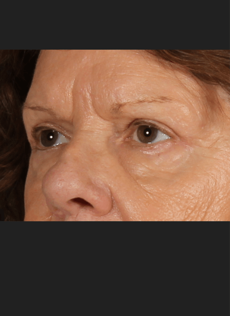 Blepharoplasty & Browlift Before & After Gallery - Patient 334684 - Image 4