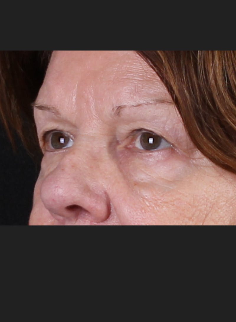 Blepharoplasty & Browlift Before & After Gallery - Patient 334684 - Image 3