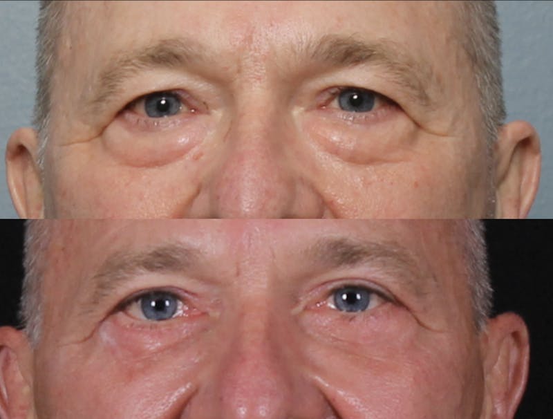Blepharoplasty & Browlift Before & After Gallery - Patient 834030 - Image 2