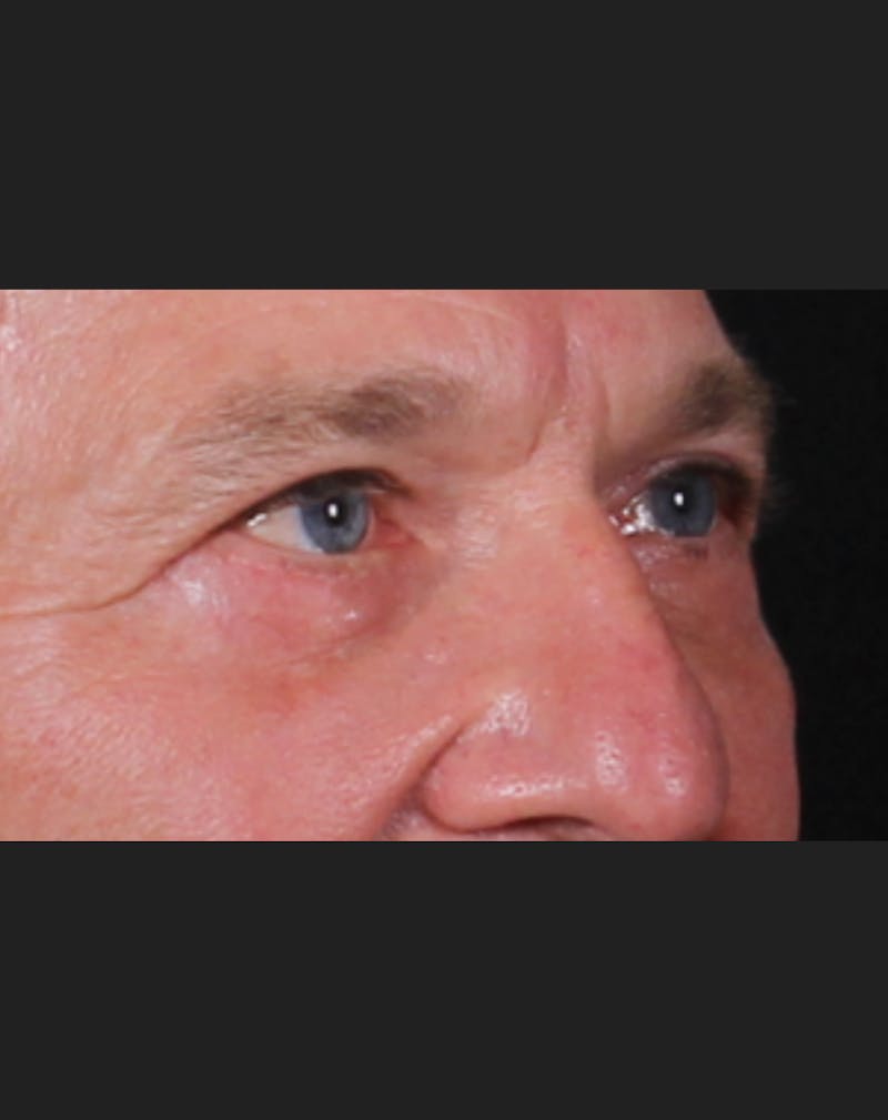 Blepharoplasty & Browlift Before & After Gallery - Patient 834030 - Image 8