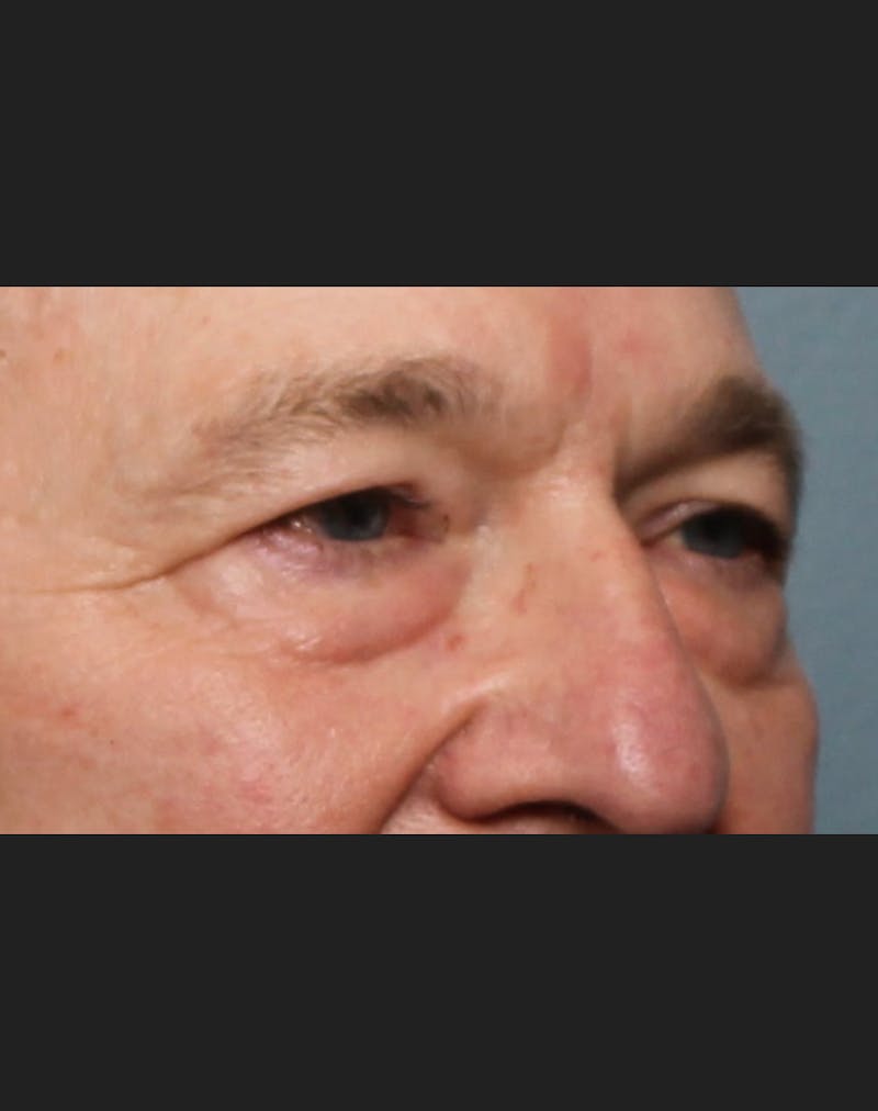 Blepharoplasty & Browlift Before & After Gallery - Patient 834030 - Image 7