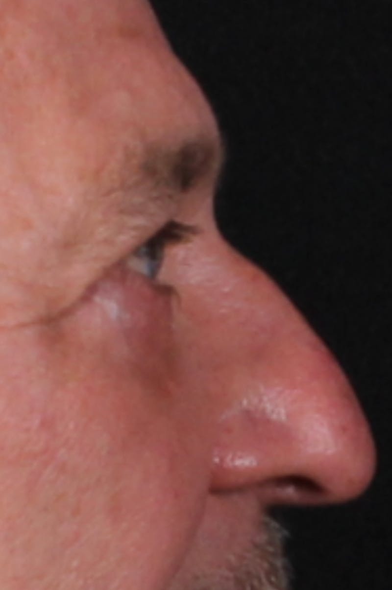 Blepharoplasty & Browlift Before & After Gallery - Patient 834030 - Image 10