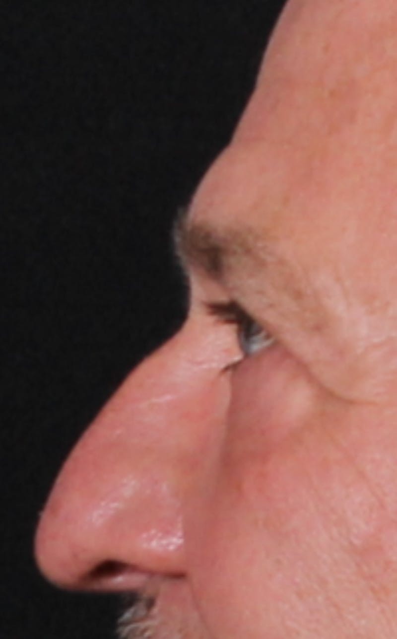 Blepharoplasty & Browlift Before & After Gallery - Patient 834030 - Image 4