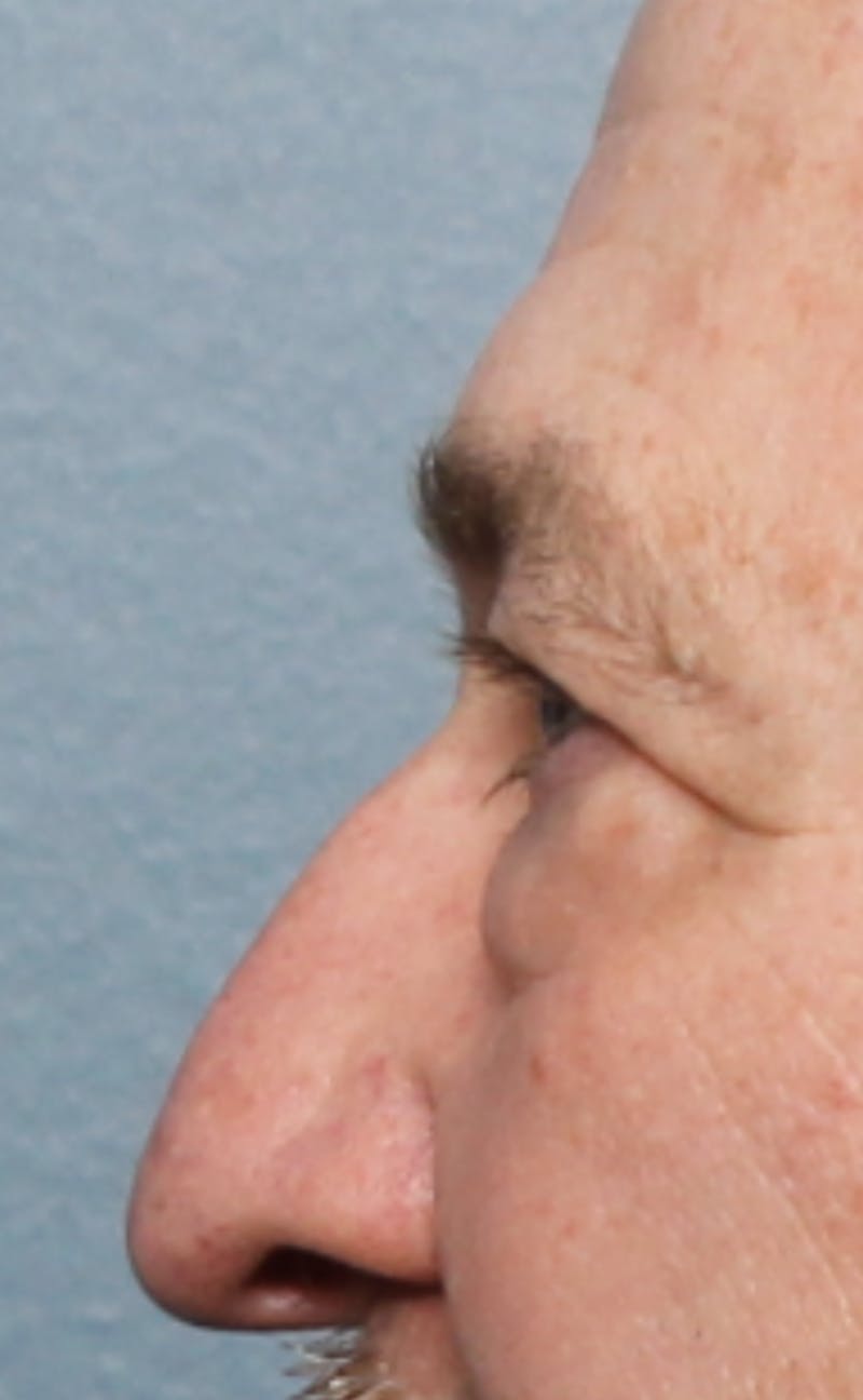 Blepharoplasty & Browlift Before & After Gallery - Patient 834030 - Image 9