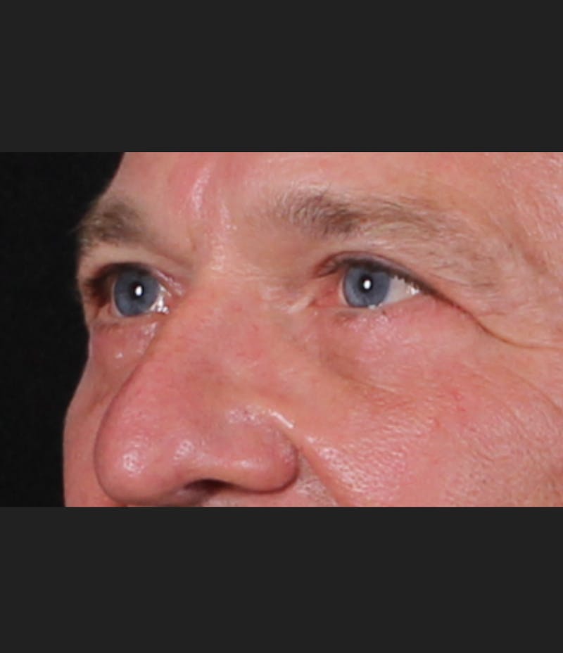 Blepharoplasty & Browlift Before & After Gallery - Patient 834030 - Image 6