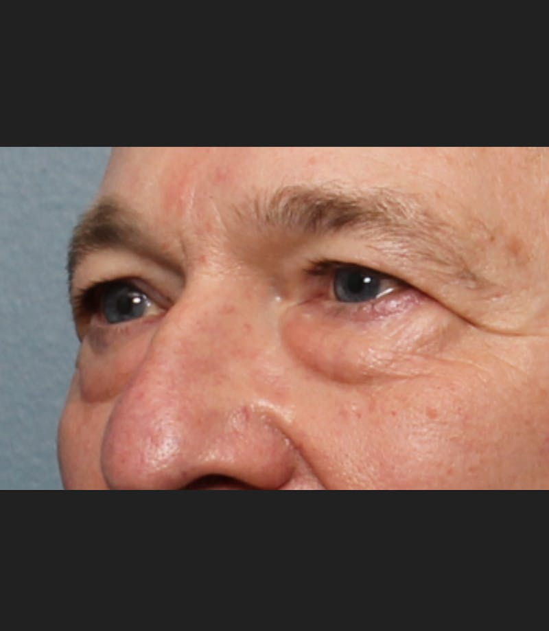 Blepharoplasty & Browlift Before & After Gallery - Patient 834030 - Image 5