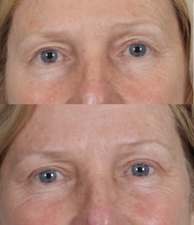 Blepharoplasty & Browlift Before & After Gallery - Patient 259956 - Image 1
