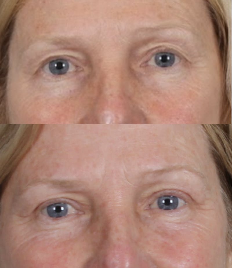 Blepharoplasty & Browlift Before & After Gallery - Patient 259956 - Image 1