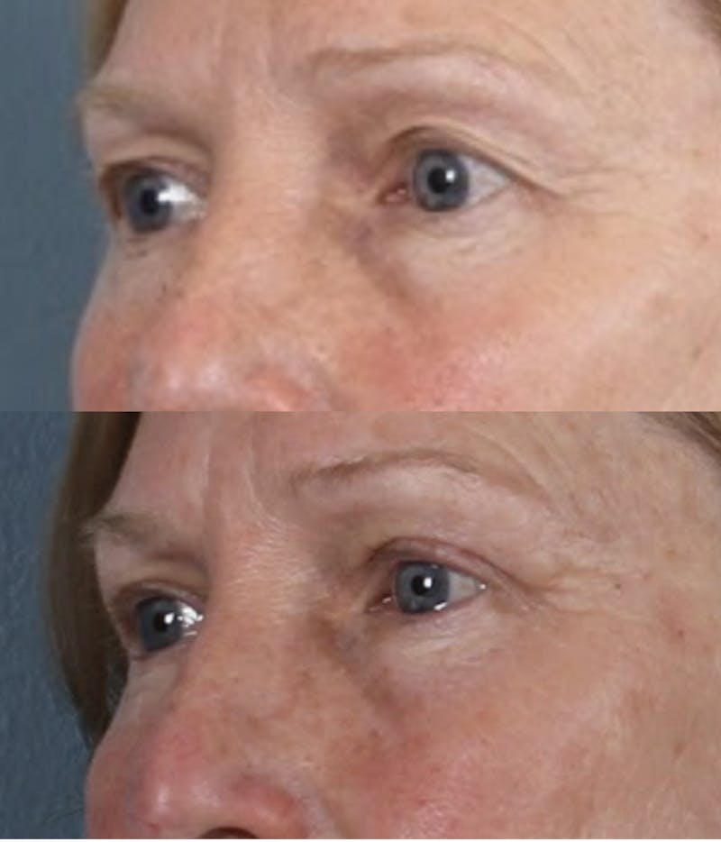 Blepharoplasty & Browlift Before & After Gallery - Patient 259956 - Image 4
