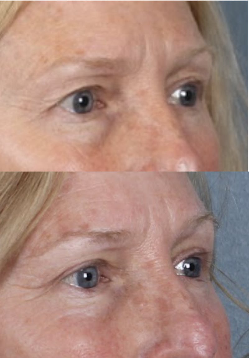 Blepharoplasty & Browlift Before & After Gallery - Patient 259956 - Image 5