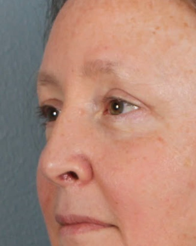 Blepharoplasty & Browlift Before & After Gallery - Patient 404154 - Image 4