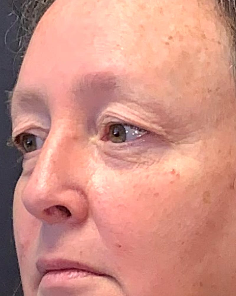 Blepharoplasty & Browlift Before & After Gallery - Patient 404154 - Image 3