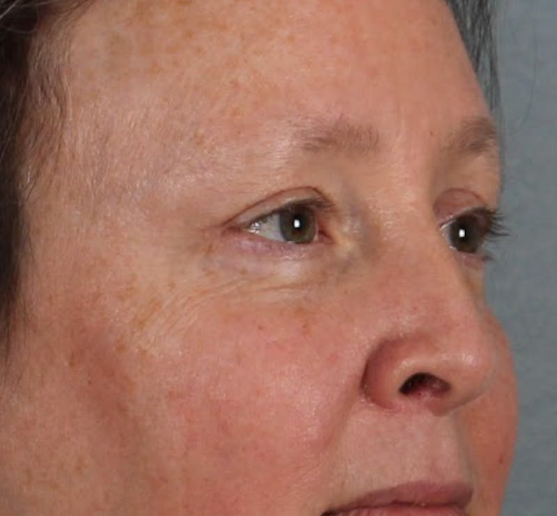 Blepharoplasty & Browlift Before & After Gallery - Patient 404154 - Image 6