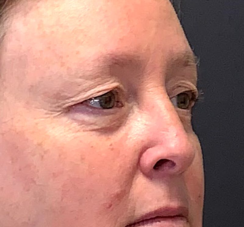 Blepharoplasty & Browlift Before & After Gallery - Patient 404154 - Image 5