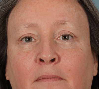 Blepharoplasty & Browlift Before & After Gallery - Patient 404154 - Image 2