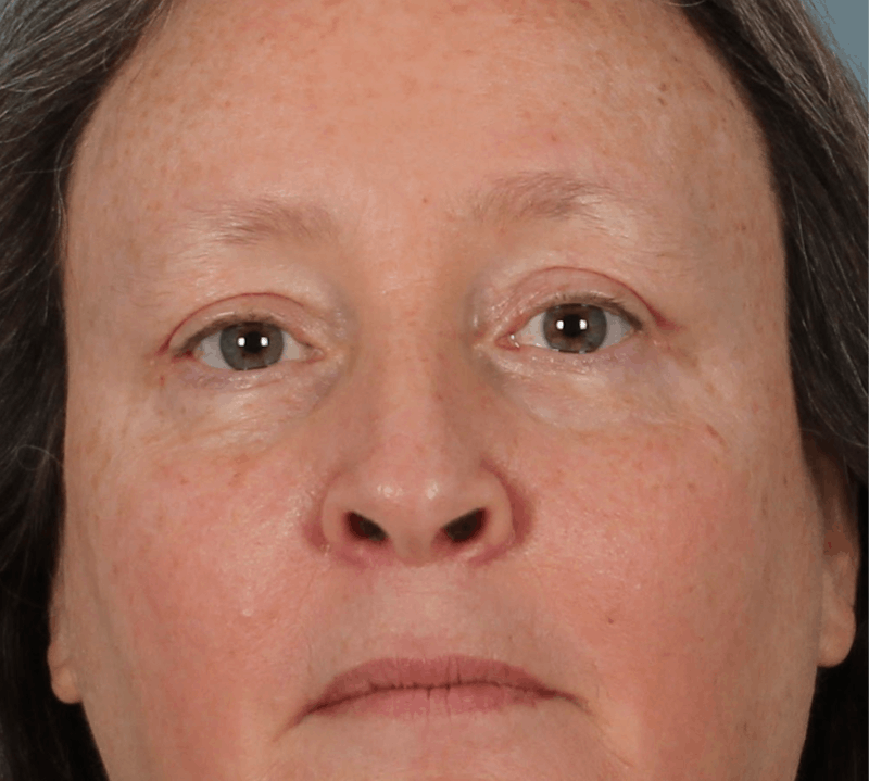 Blepharoplasty & Browlift Before & After Gallery - Patient 404154 - Image 2