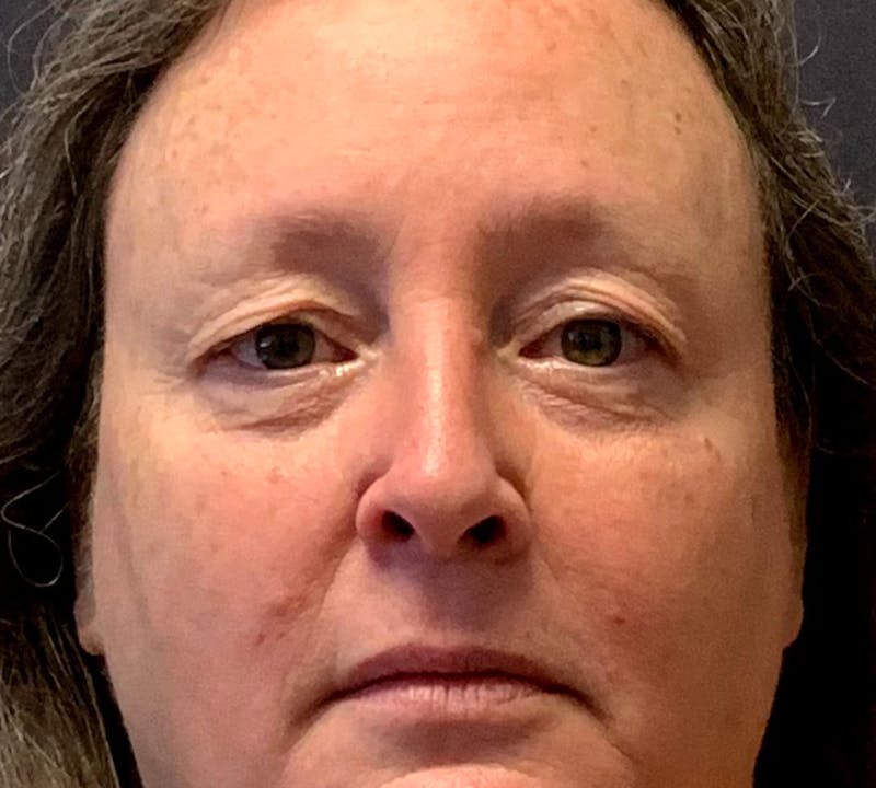 Blepharoplasty & Browlift Before & After Gallery - Patient 404154 - Image 1