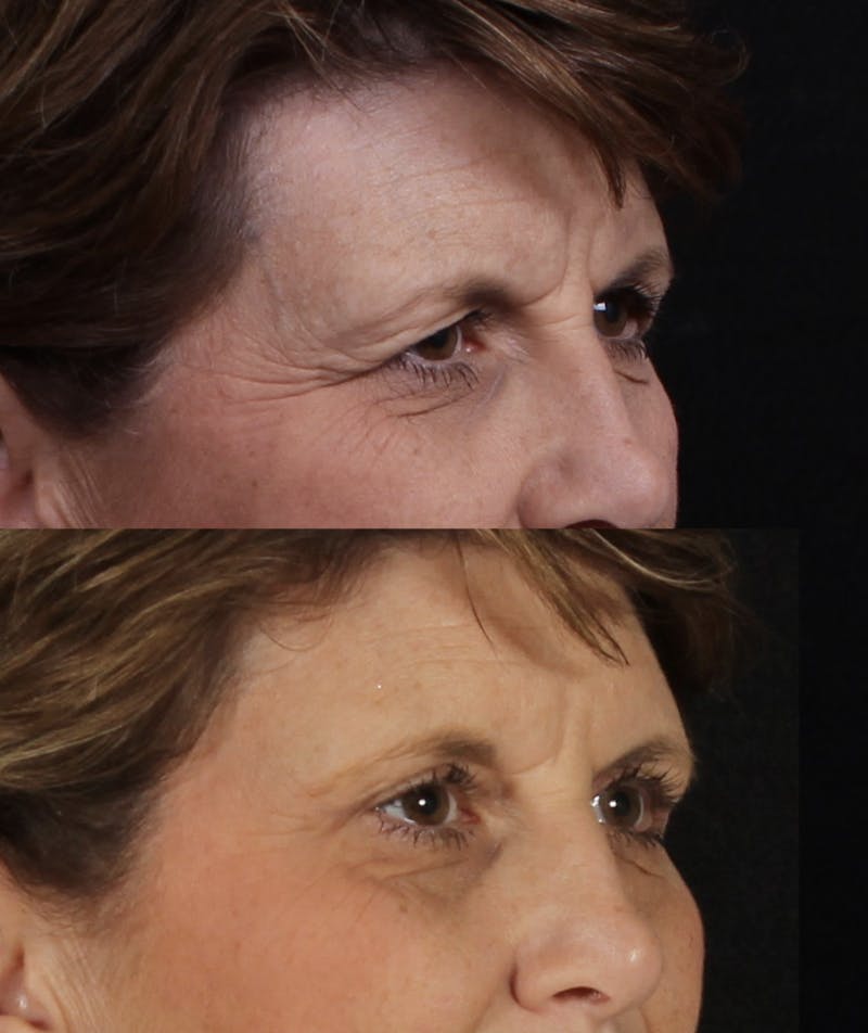 Blepharoplasty & Browlift Before & After Gallery - Patient 211912 - Image 3