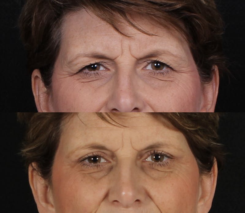 Blepharoplasty & Browlift Before & After Gallery - Patient 211912 - Image 2