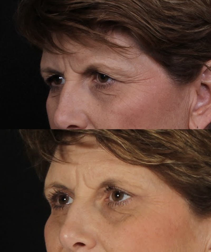 Blepharoplasty & Browlift Before & After Gallery - Patient 211912 - Image 6