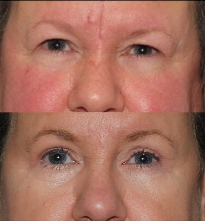 Blepharoplasty & Browlift Before & After Gallery - Patient 107110 - Image 2