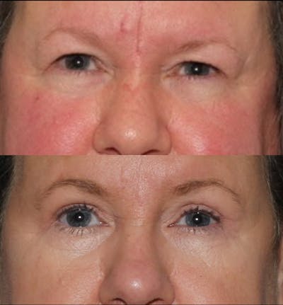 Blepharoplasty & Browlift Before & After Gallery - Patient 107110 - Image 1