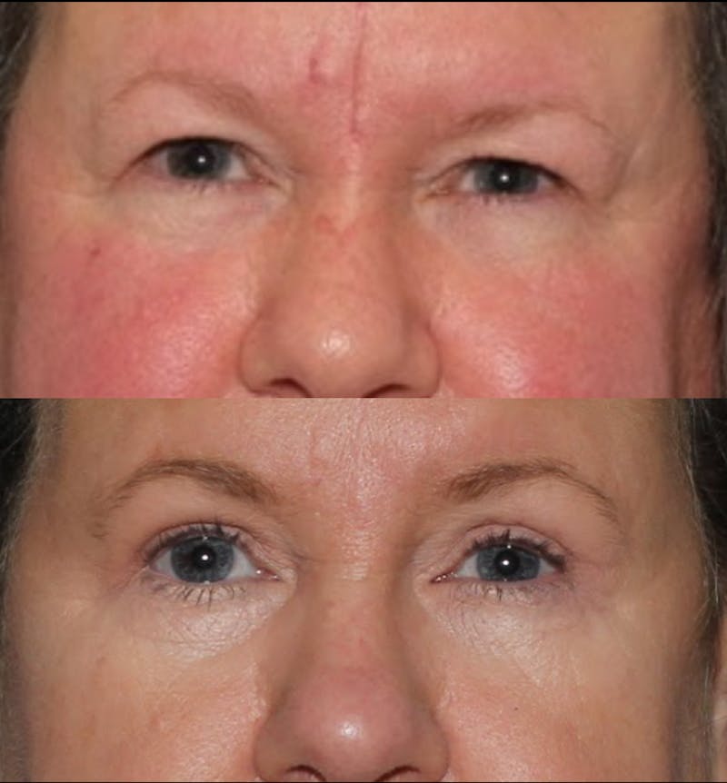 Blepharoplasty & Browlift Before & After Gallery - Patient 107110 - Image 1