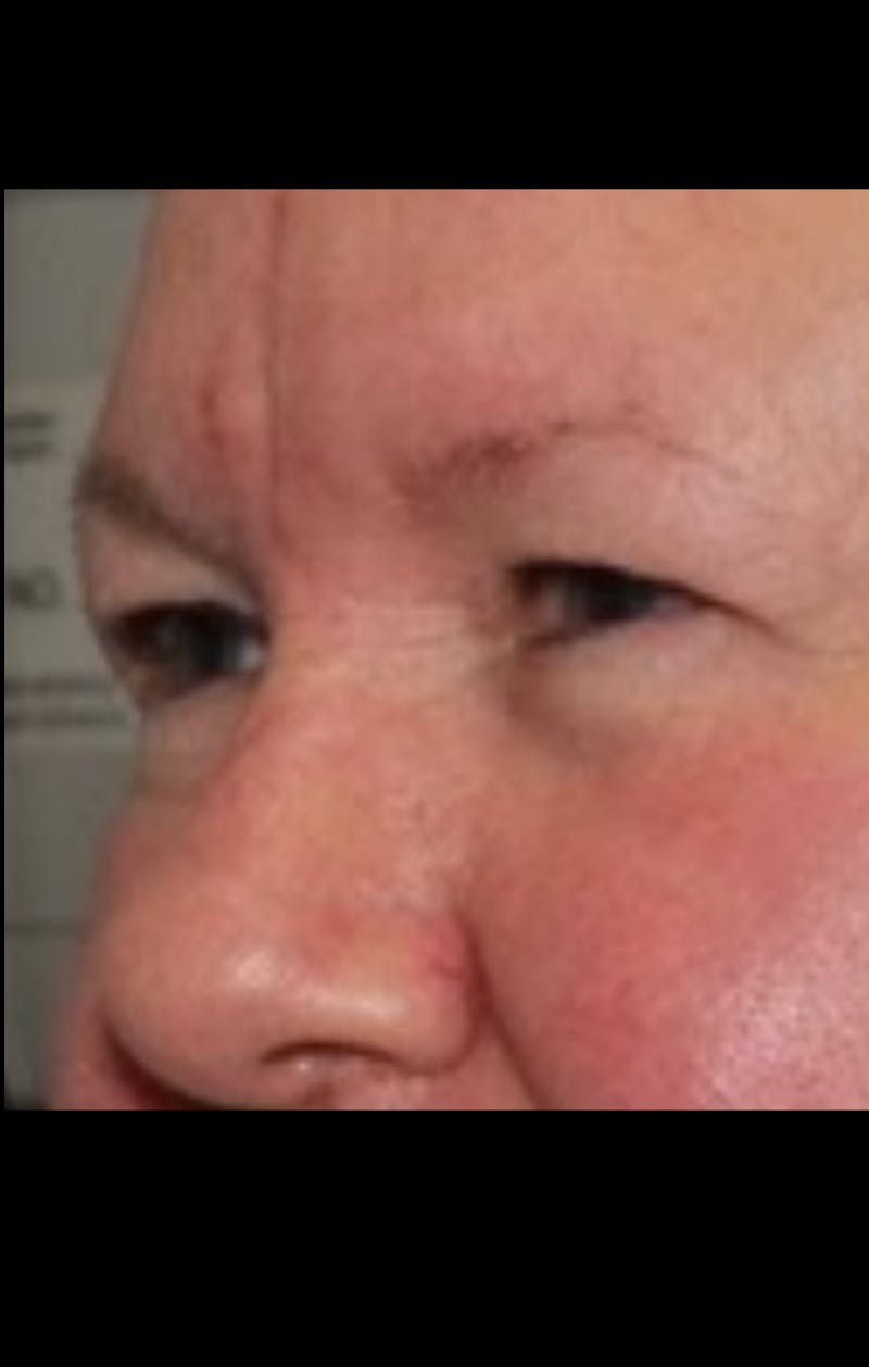 Blepharoplasty & Browlift Before & After Gallery - Patient 107110 - Image 3