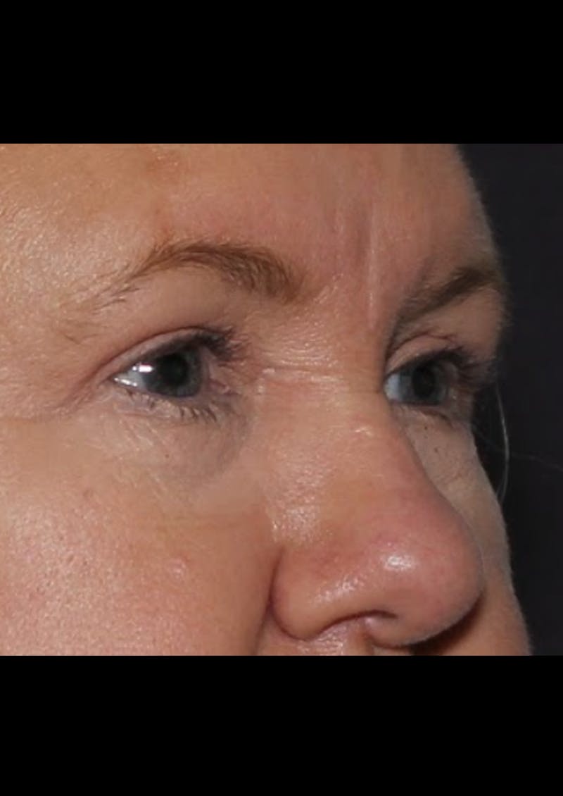 Blepharoplasty & Browlift Before & After Gallery - Patient 107110 - Image 6