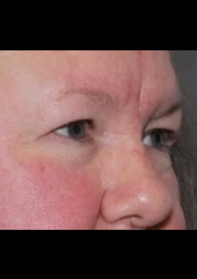 Blepharoplasty & Browlift Before & After Gallery - Patient 107110 - Image 5