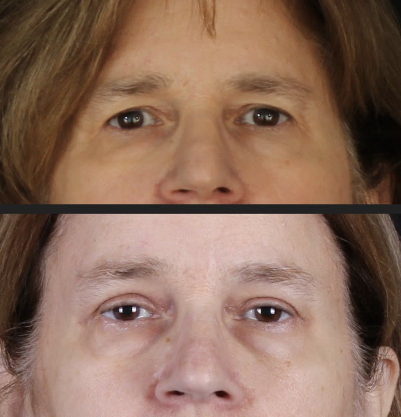 Blepharoplasty & Browlift Before & After Gallery - Patient 231414 - Image 1