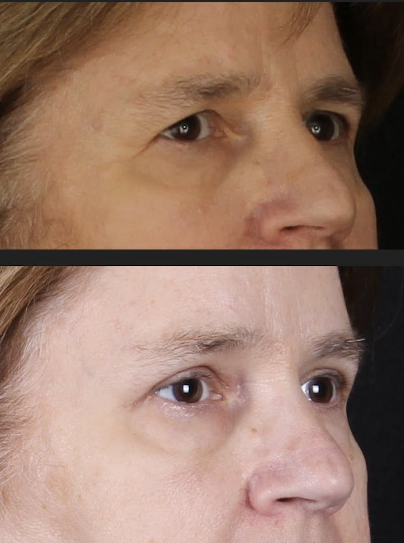 Blepharoplasty & Browlift Before & After Gallery - Patient 231414 - Image 4