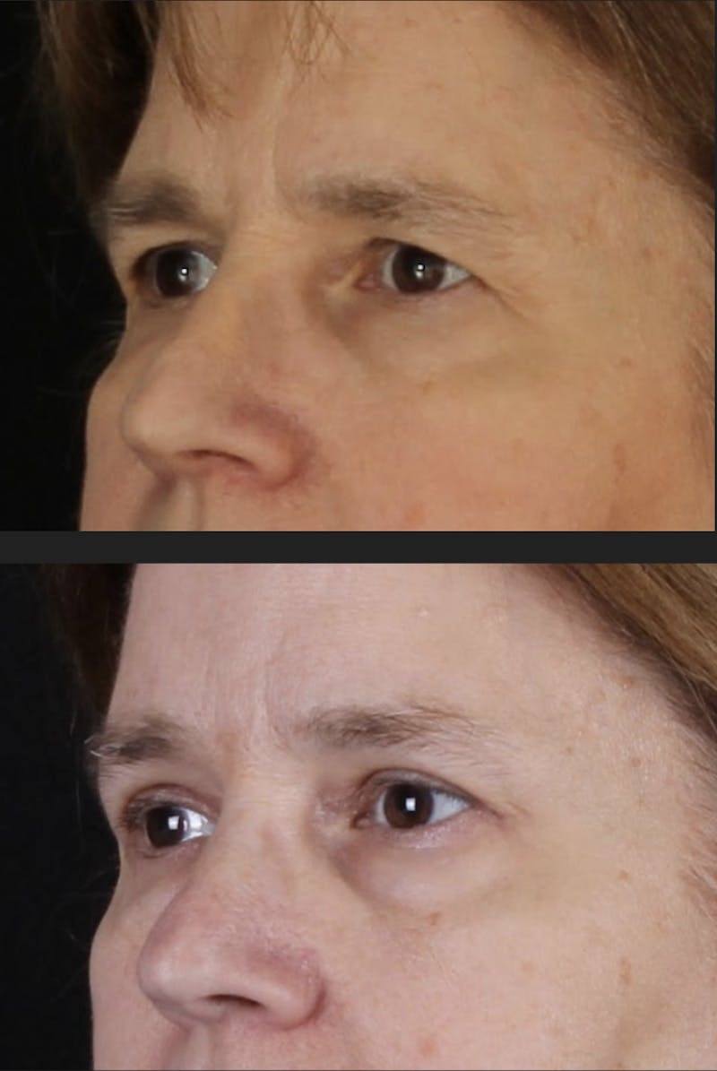 Blepharoplasty & Browlift Before & After Gallery - Patient 231414 - Image 5