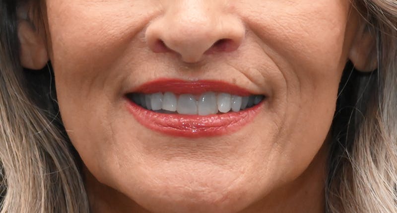 Lip Lift Before & After Gallery - Patient 301052 - Image 2
