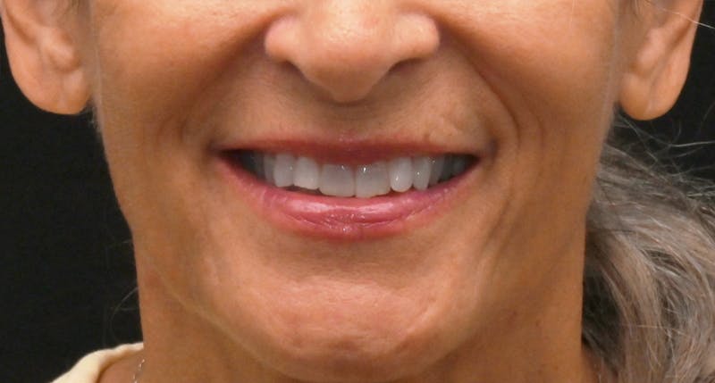 Lip Lift Before & After Gallery - Patient 301052 - Image 1