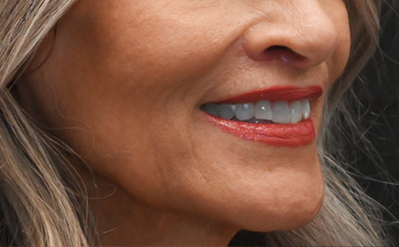 Lip Lift Before & After Gallery - Patient 301052 - Image 4