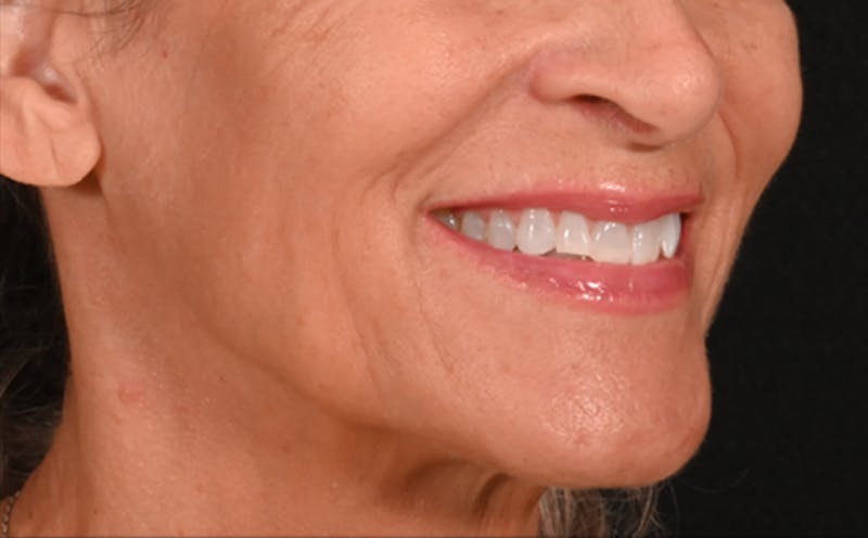 Lip Lift Before & After Gallery - Patient 301052 - Image 3