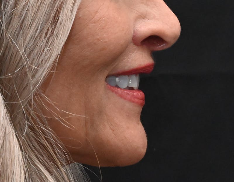 Lip Lift Before & After Gallery - Patient 301052 - Image 6